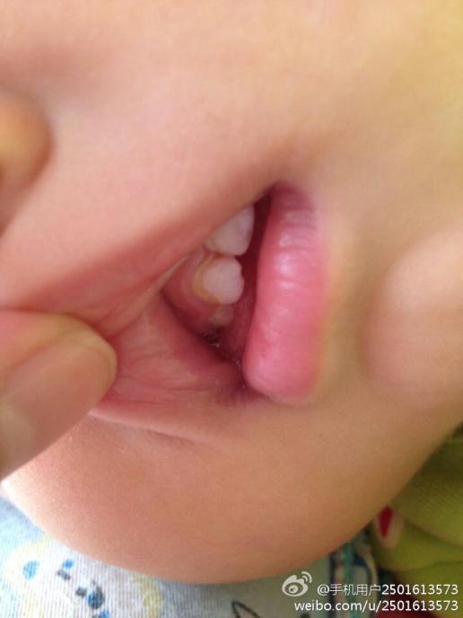 我家宝宝1岁2个月,牙齿钙化严重,根部已经开始被腐蚀了,请问要怎样