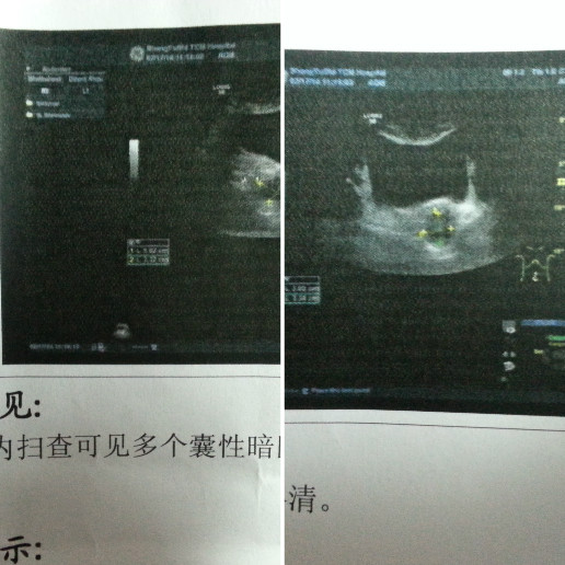 这属于正上吗子宫全切一月后复查发现盆腔内扫查多个囊性暗区?