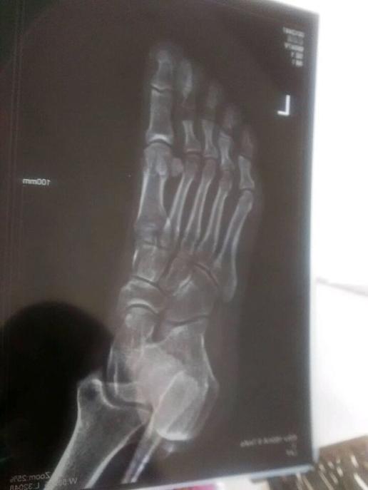 x光片判断受伤情况 这张图上是骨折还是断了伤点在第二个脚趾?