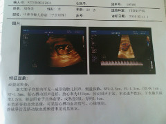 怀孕十四周做B超显示BPD=2.5CM、FL=1.3C