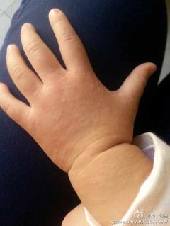 宝宝30个月,得了摩擦性苔癣样疹,请问怎么治疗