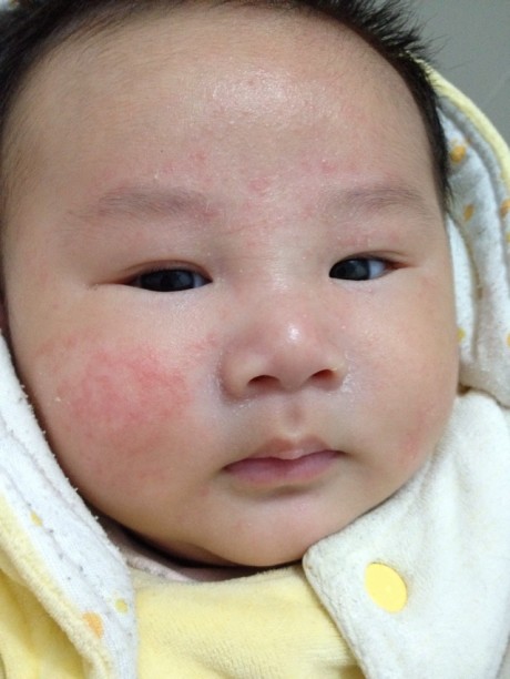 肤2013,读毛主席在花山后感,婴儿湿疹症状,北京南站停车场收费