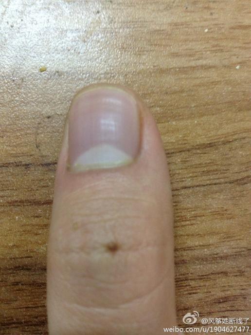 【大拇指旅行】右手大拇指有颗痣,天生的,这代表什么