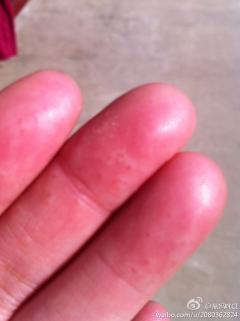 手指跟手掌长了很多这种小水泡像是在皮肤里面