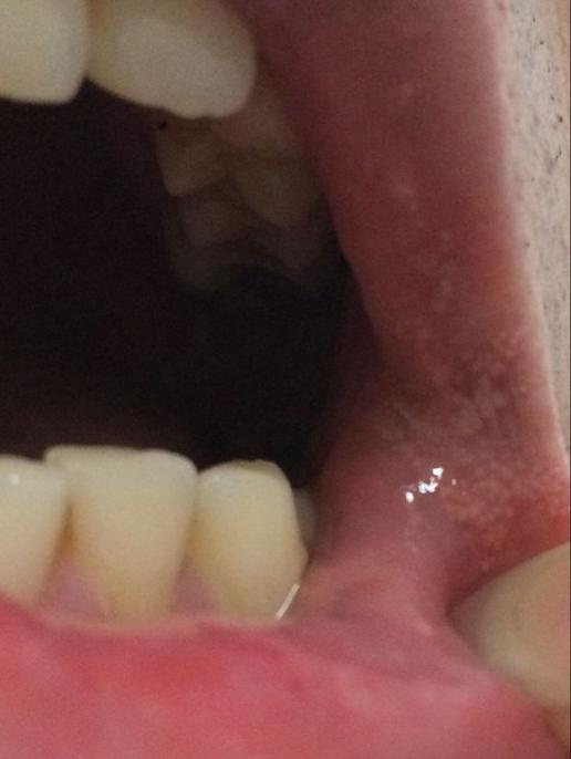 口腔腔壁和嘴角内部都是这种白色点点是什么东西?