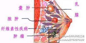 引起积乳囊肿的原因有哪些 乳腺囊肿的主要症状有哪些?