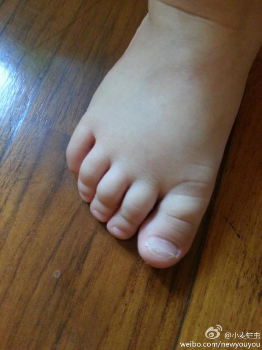 请问19月宝宝脚指甲大拇指出现横裂纹是啥原因呀?