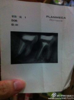哺乳期,去口腔医院,说有脓肿先手术在拔牙可能
