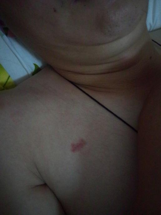 如何辨别吻痕和皮肤过敏 我老公身上出现红斑?