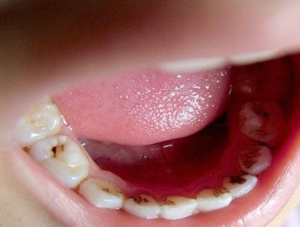 牙齿的牙垢能用手扣吗