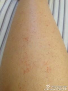 我小腿皮肤下面的红点点是什么啊。不痛不痒的