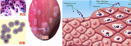 典型的尖锐湿疣疣体表面是粗糙,凹凸不平的,外观一般呈现刺状,菜花状