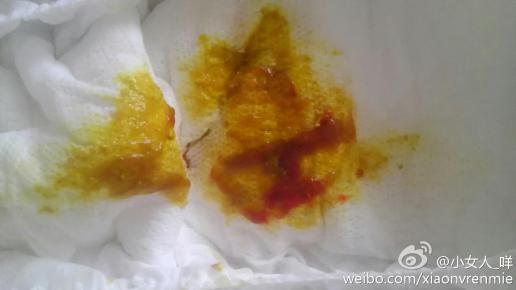 有什么问题吗, 2个月的宝宝拉的便便有痰一样的血?