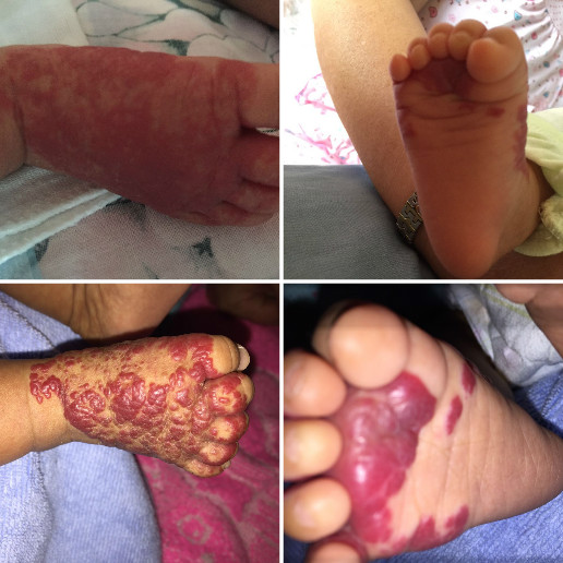 请问,宝宝现在两个月得了血管瘤 在出生第七天发现脚面红色印记鼓起?