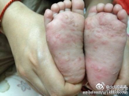 宝宝8个月了 但是从2个月起脚上一直有汗疱疹 医生说是属于湿疹一种