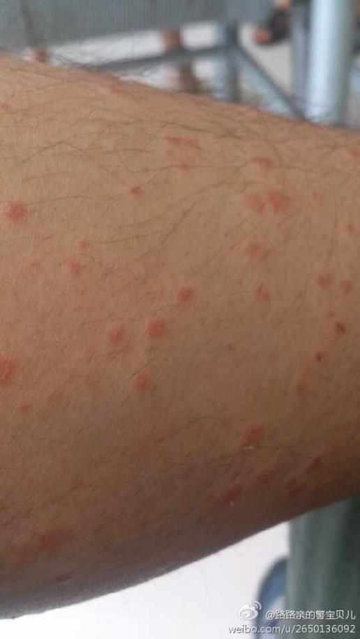 下我这是什么皮肤病,有的医生说我这是点滴状银屑病,有的诊断是荨麻疹