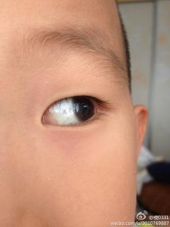 小孩子眼白有黑点是什么原因啊?对小孩子有什