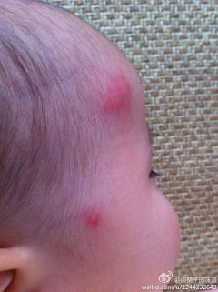 我家宝宝十个月打A群流脑疫苗,下午发现脑袋,