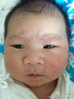 我家宝宝30天,脸上头上起了湿疹,眉毛处结痂黄