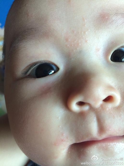 催医生请问一下宝宝脸上是过敏还是奶癣啊?