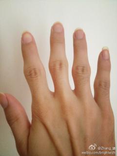 我的手指关节好粗啊,有什么办法弄细吗