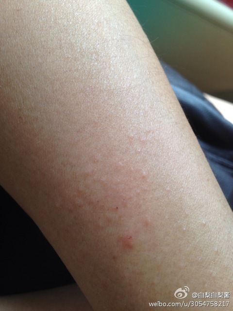 妈妈的手臂只要一晒多太阳就会起这种又红又痒的疹,请问是紫外线过敏