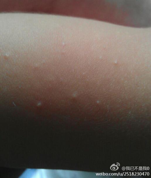 我就宝宝11个月了,前段时间手臂上腿上有一点点的痘痘,有的还有白点