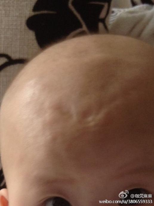 能帮我看看我家宝宝额头上面凹进去一点是什么原因吗?
