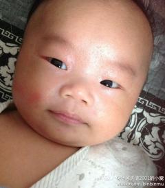 我家宝宝出生快80天了,眼睛一直有红血丝,巩膜