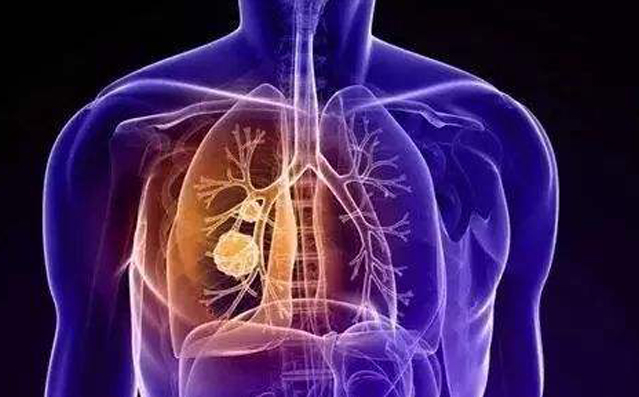新冠肺炎主要引起深部气道和肺泡损伤为特征的炎性反应,肺部纤维化