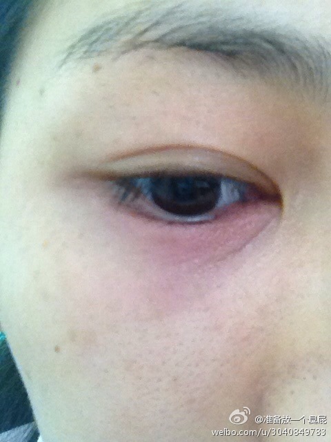 这是什么节奏眼睛麦粒肿?