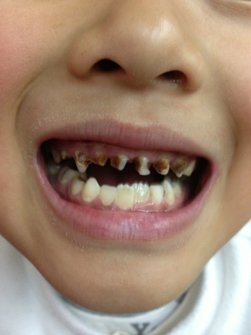 宝宝三岁牙齿烂了换牙的时候牙根会掉吗?