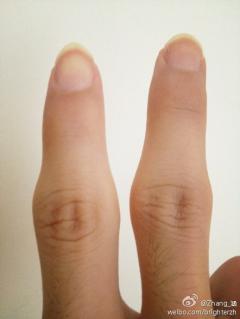 我的手指关节好粗啊,有什么办法弄细吗,尤其是