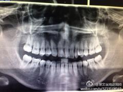 患者男29岁,上颌中切牙间一多生牙,12,22几年