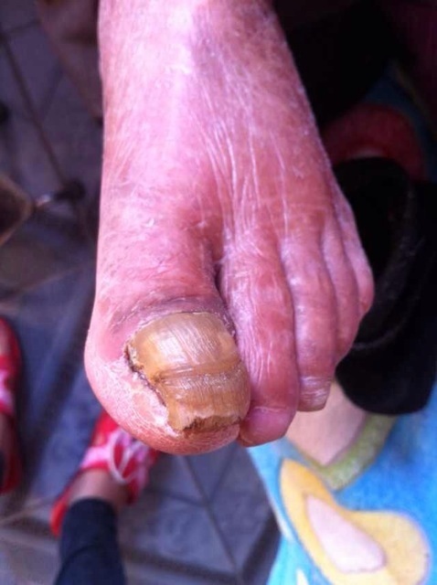 脚趾指甲变厚发黄并伴有疼痛已一年有余,请问是什么病,该如何治疗