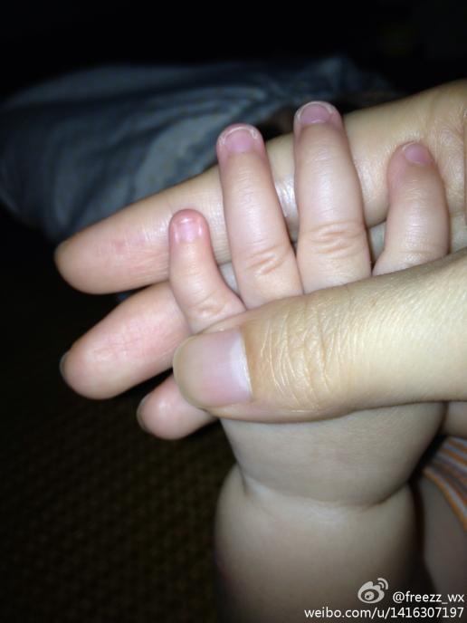 我家宝宝生下了小手指最上面的关节就有点弯 现在