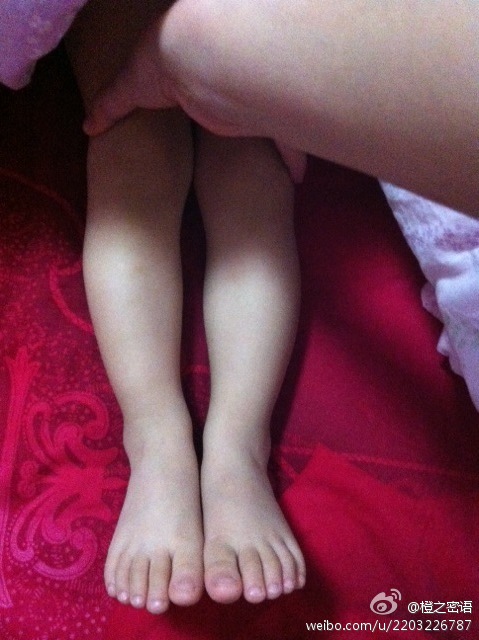 男宝1岁2个月,左脚