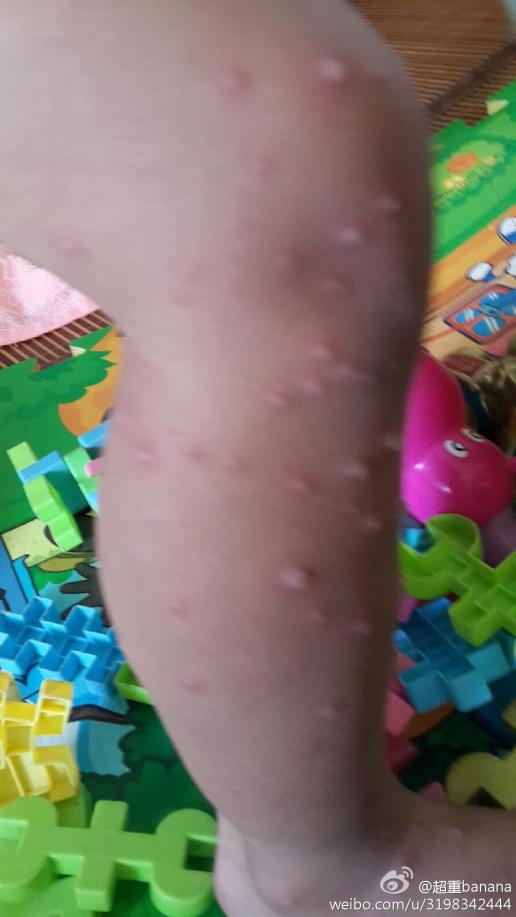 请问有谁知道,这是出水痘吗?两岁多的小孩.