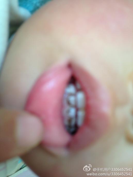 我家宝宝19个月了牙齿都变黑了是缺钙吗?