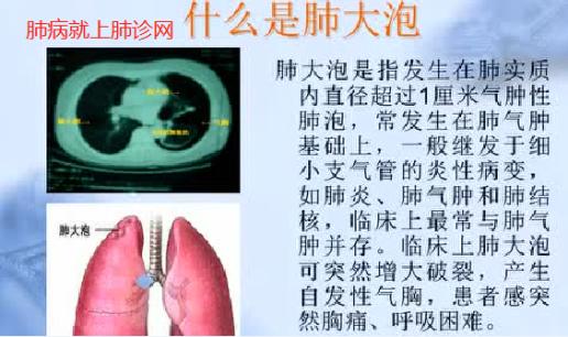 肺大泡可以手术治疗吗?以后是不是不能运动了