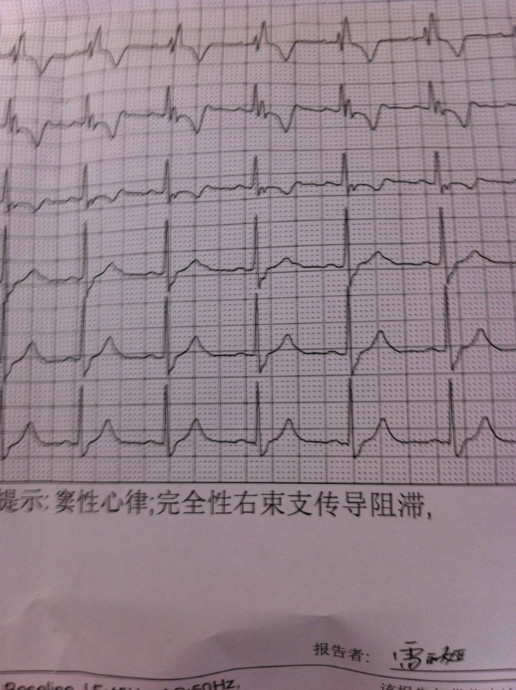 完全性右束支传导阻滞是怎么回事?