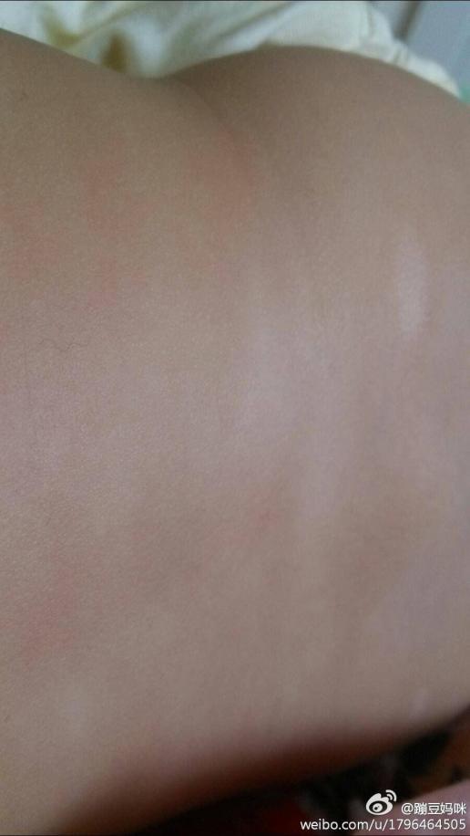 我家宝宝四个多月,腰部有白色斑块,请问这个是皮肤病吗?