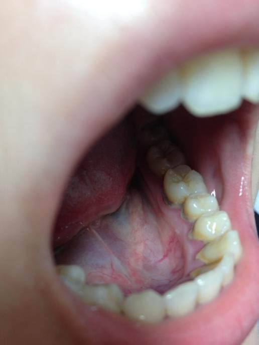 牙齿里面板牙有的是什