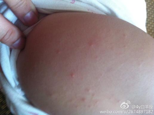好评回答 2013-09-18 13:27:08 热疹即痱子,是夏季小儿常见的皮肤病