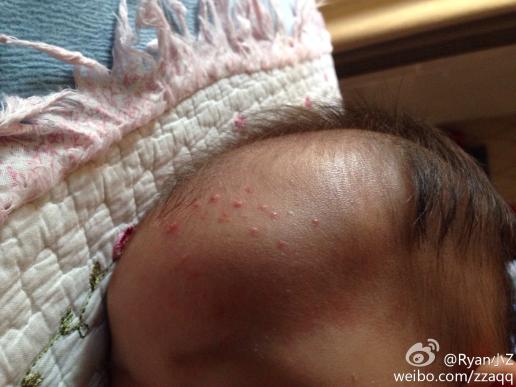 宝宝反复发烧三天 额头上出现很多图片中这样的红点 而且不是烧退后出
