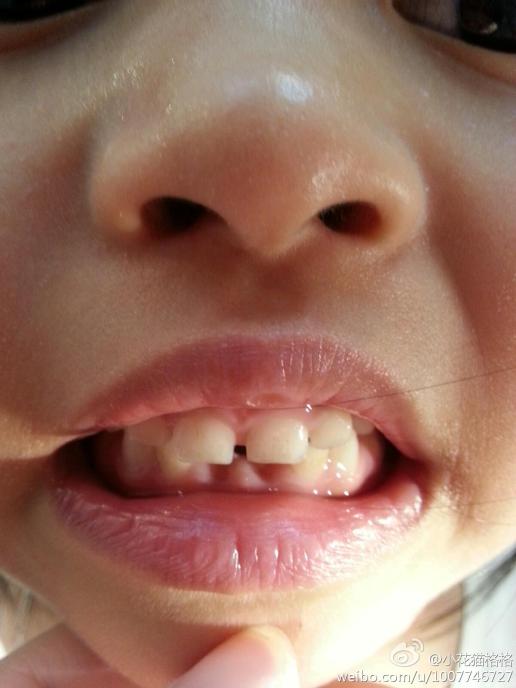 医生,您好,我小孩5岁8个月,最近发现孩子门牙不是很光滑,有划痕,请问