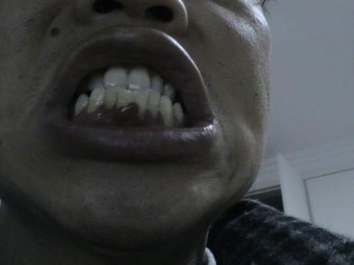 下门牙牙龈肿大 下门门牙牙齿肿大?