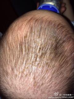 宝宝11个月,发现头顶长了许多疤,都集中在前卤