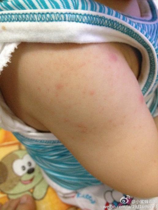 宝宝最近天热,就爱出这种小红疹子,手臂身上都是汗,请问这个是湿疹