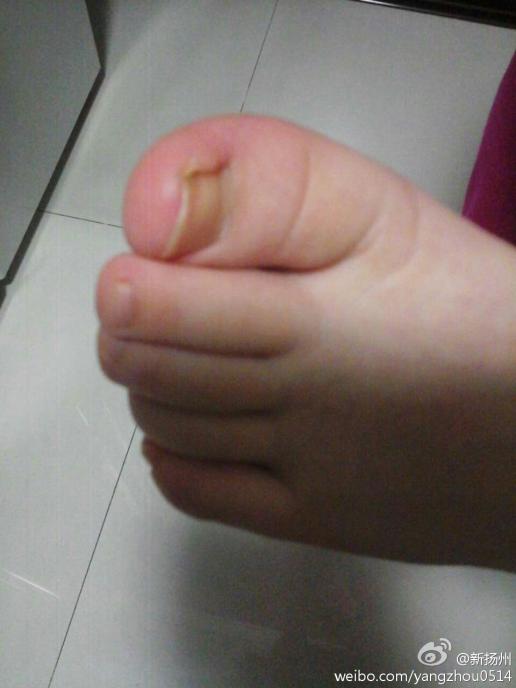 一男童,今年3岁半,左右脚大拇指均有